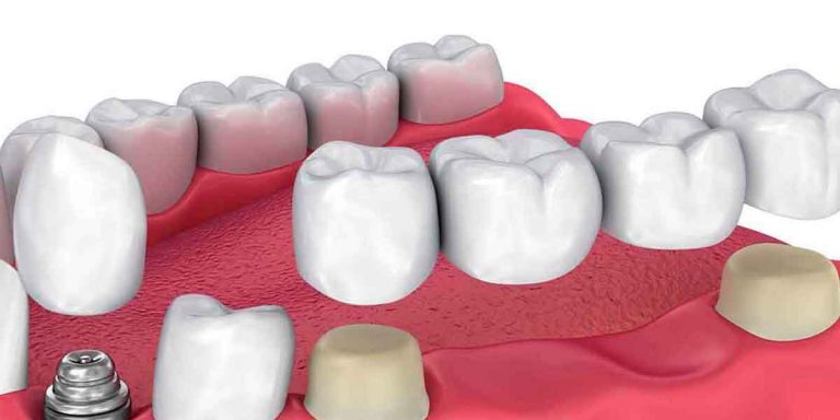 Is a Dental Implant Treatment Better Than a Bridge